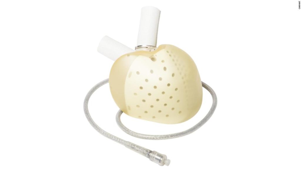 French company Carmat has developed a &quot;total artificial heart.&quot;